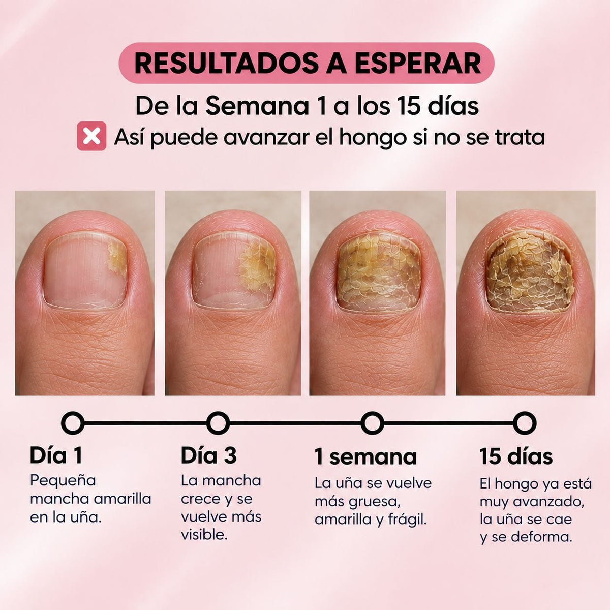 PARCHES ANTI-HONGOS PARA UÑAS