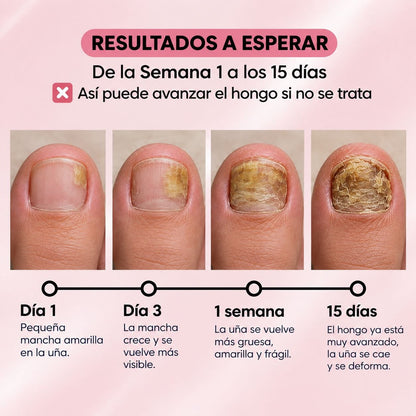 PARCHES ANTI-HONGOS PARA UÑAS